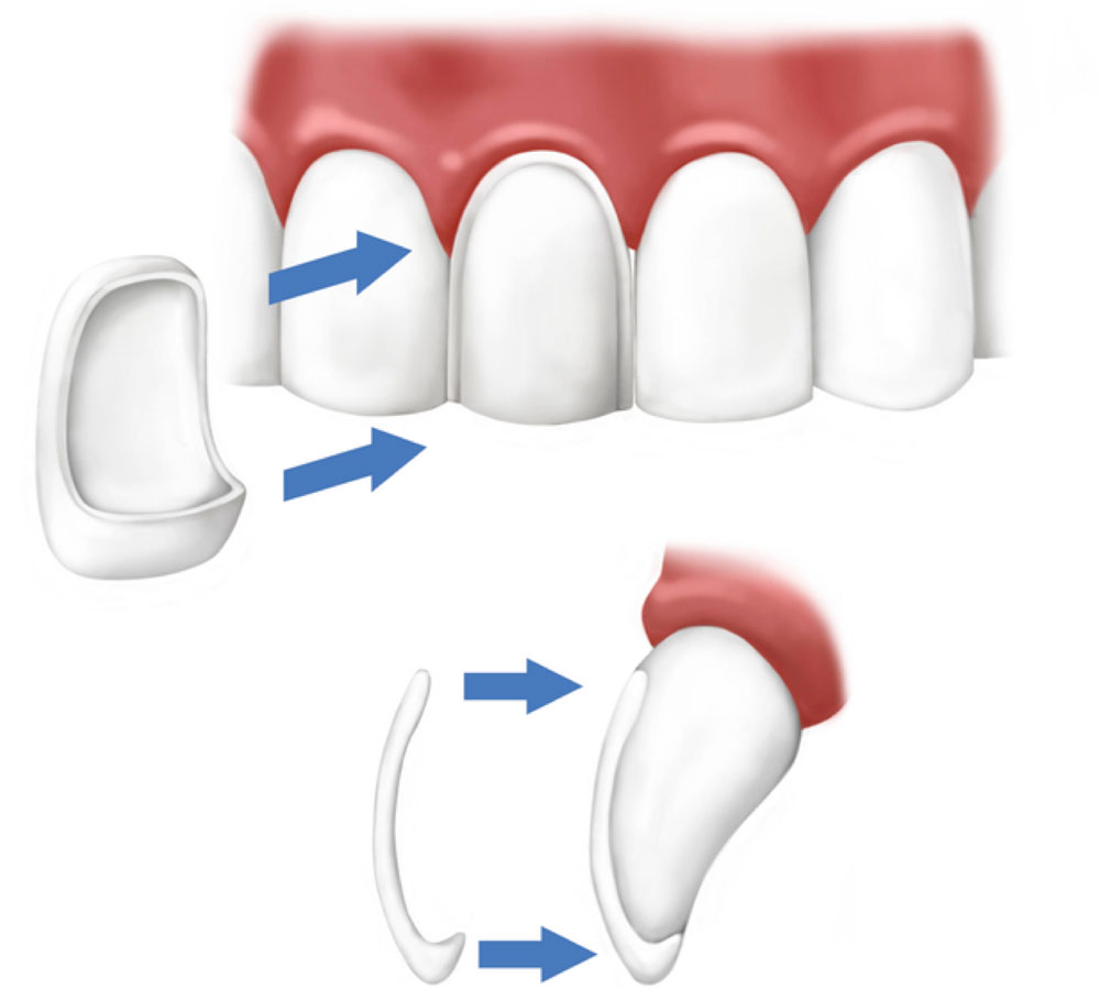 Veneers E-Max Veneers IST Smile Experts Hollywood Smile