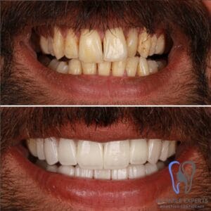 Dramatic before and after of a patient's smile makeover with E-MAX porcelain veneers. Before shows discolored teeth; after reveals a perfect Hollywood Smile by IST Smile Experts in Turkey.
