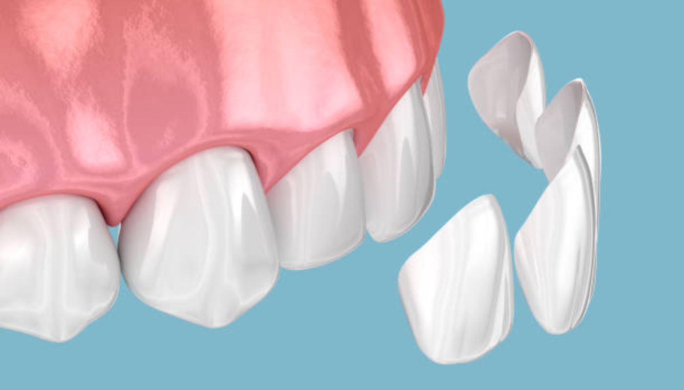 E-Max Veneers in Turkey