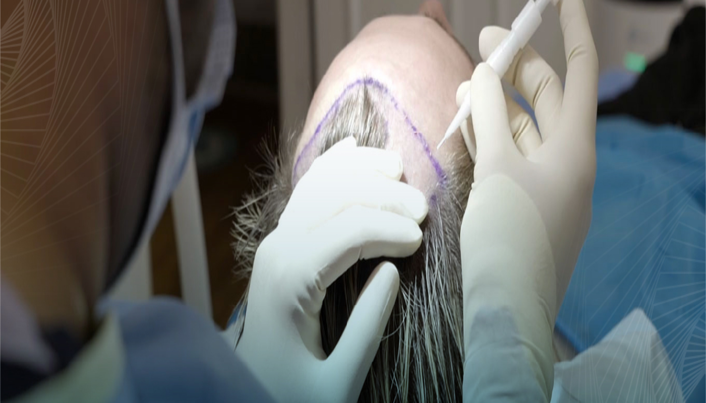 DHI Hair Transplant in Turkey