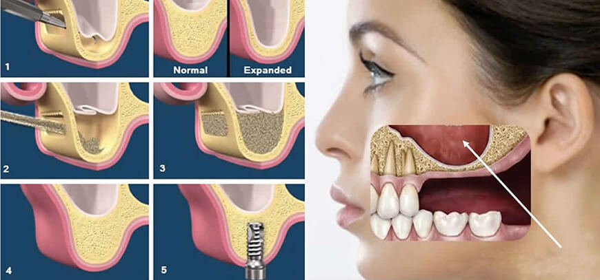 sinus-lifting Sinus Lifting in Turkey