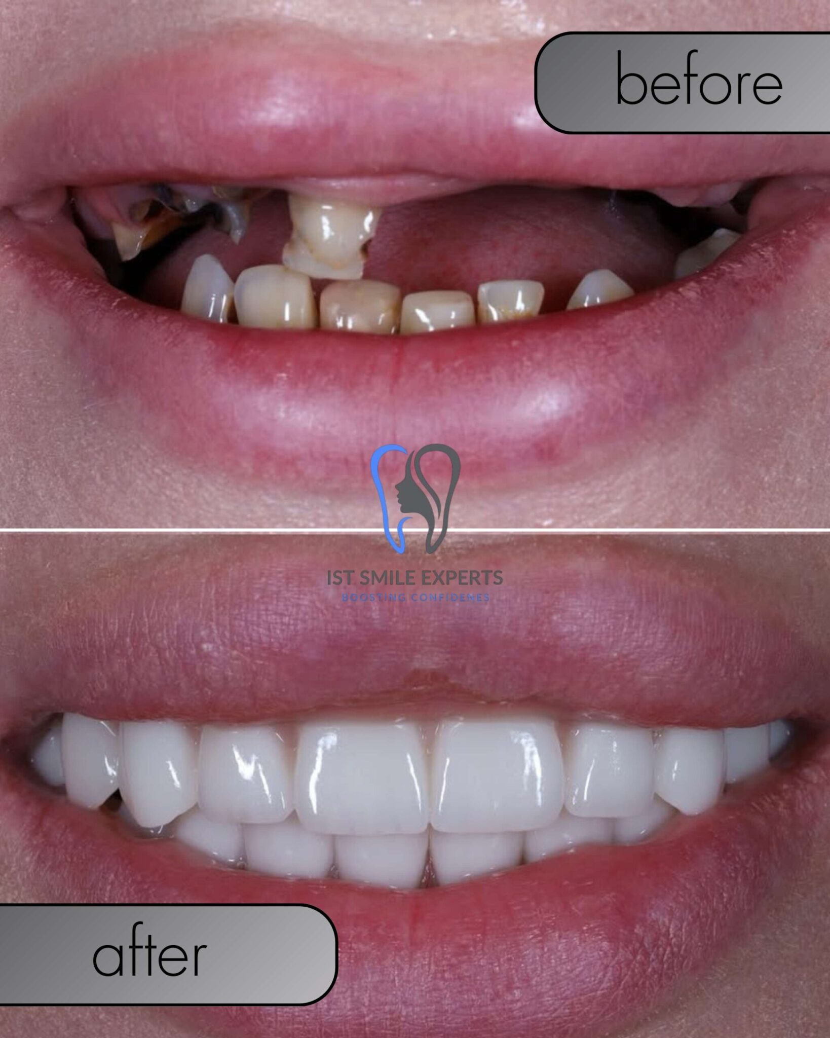 All-on-4 dental implants before and after at IST SMILE EXPERTS