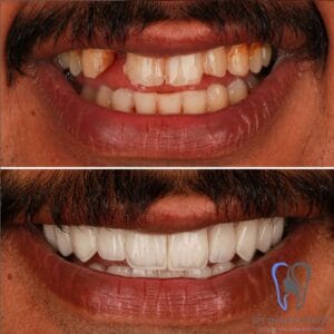 Dramatic before and after of a man's full smile restoration using Zirconium Crowns in Turkey. Before shows severely damaged and missing teeth; after reveals a perfect, brilliant Hollywood Smile by IST Smile Experts.
