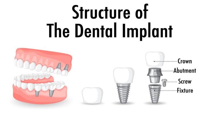 Structure of dental implant