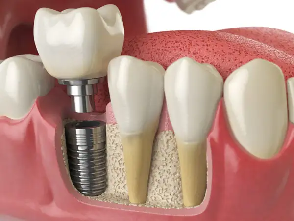 dental bone grafting and dental implant