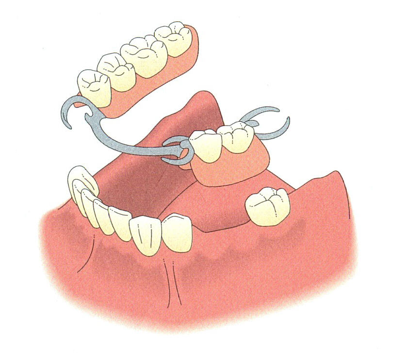 Removable Dentures