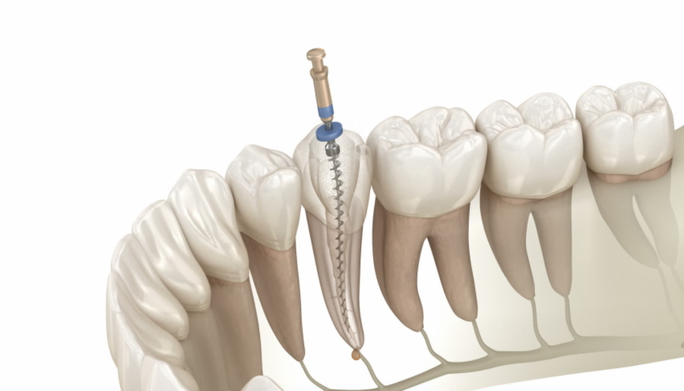 Root Canal Procedure