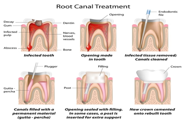 Root Canal Procedure