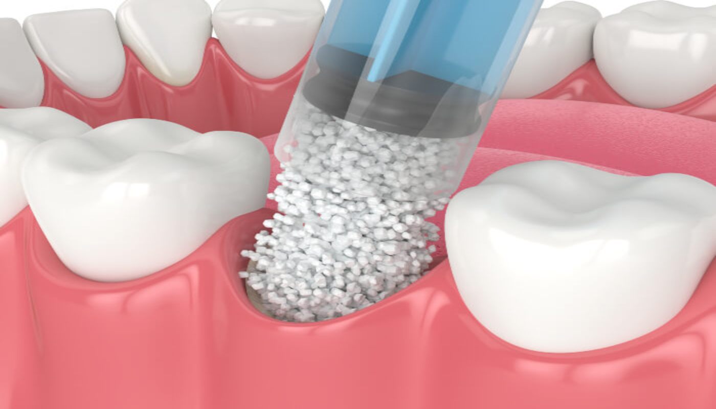 dental bone grafting and dental implant Bone graft in dentistry