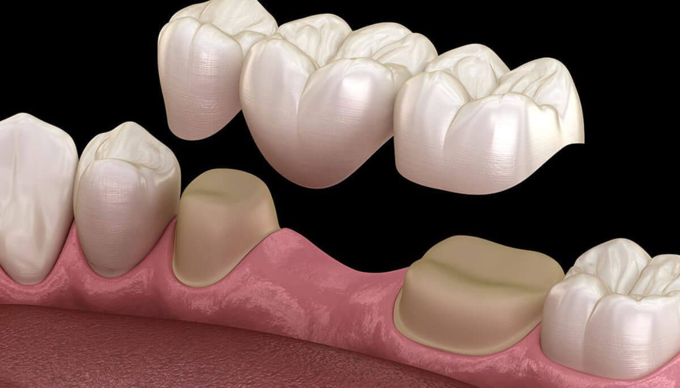 Dental bridges in Istanbul