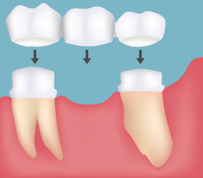 Dental bridges in Istanbul