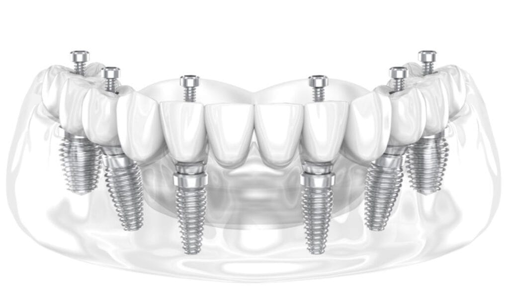 All-on-4 in Turkey for Canadians compared with an All-on-6 full-arch dental implant model