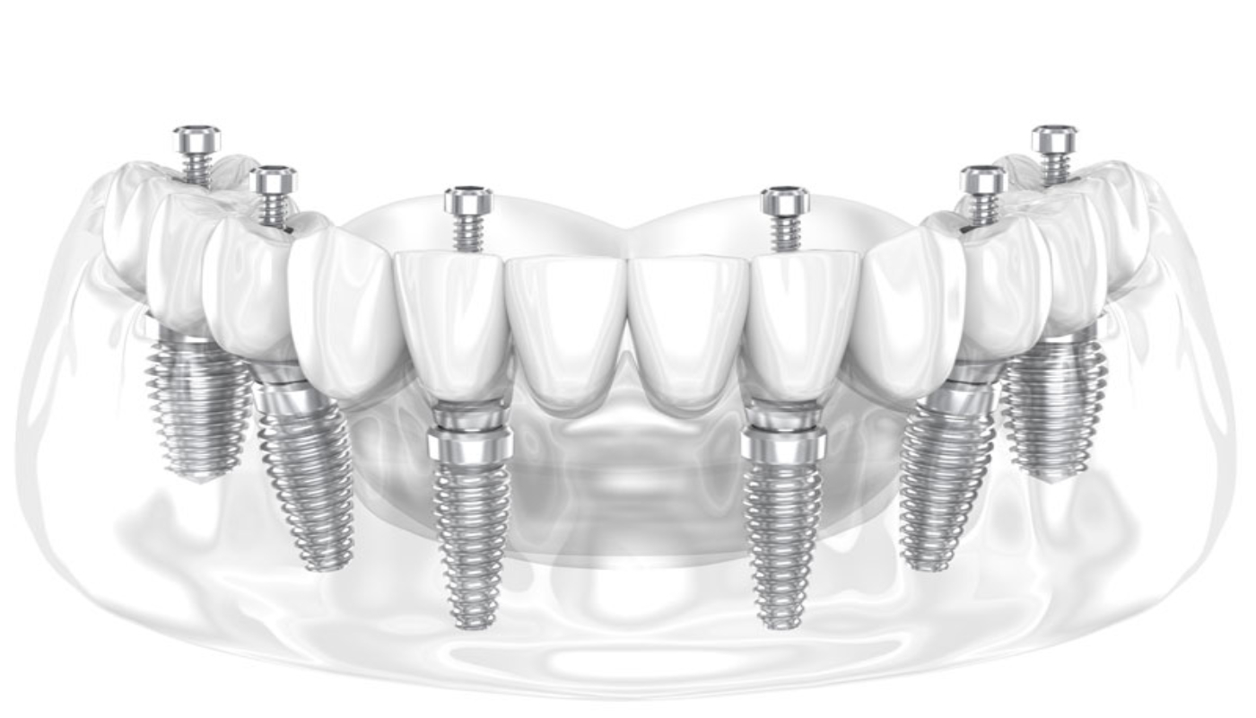 Illustration of All on 6 dental implants showing six titanium implants supporting a full-arch prosthetic.