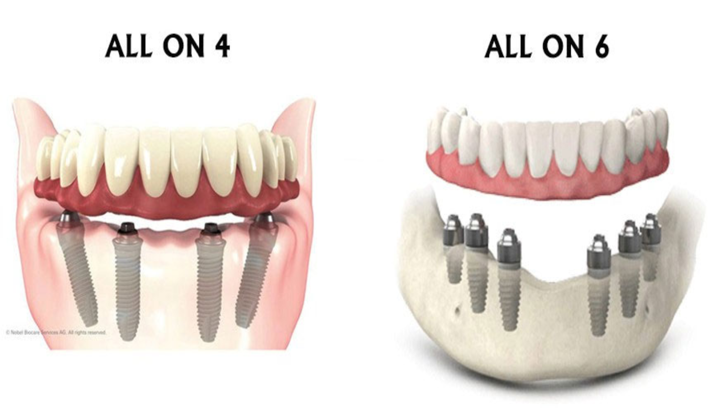 all on 4 and all on 6 dental implants