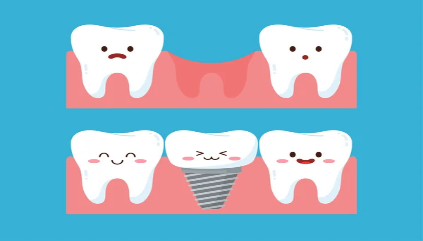 Choosing the Right Dental Implants