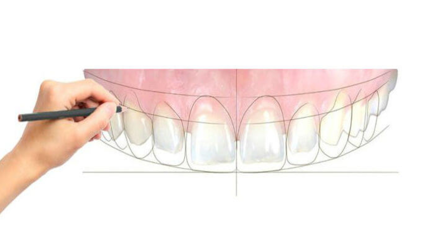 Smile Makeovers in Turkey