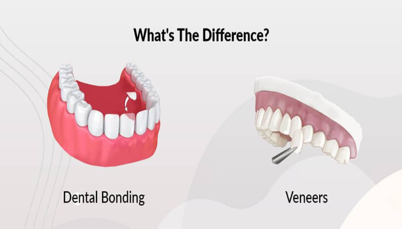 Composite Bonding vs Veneers