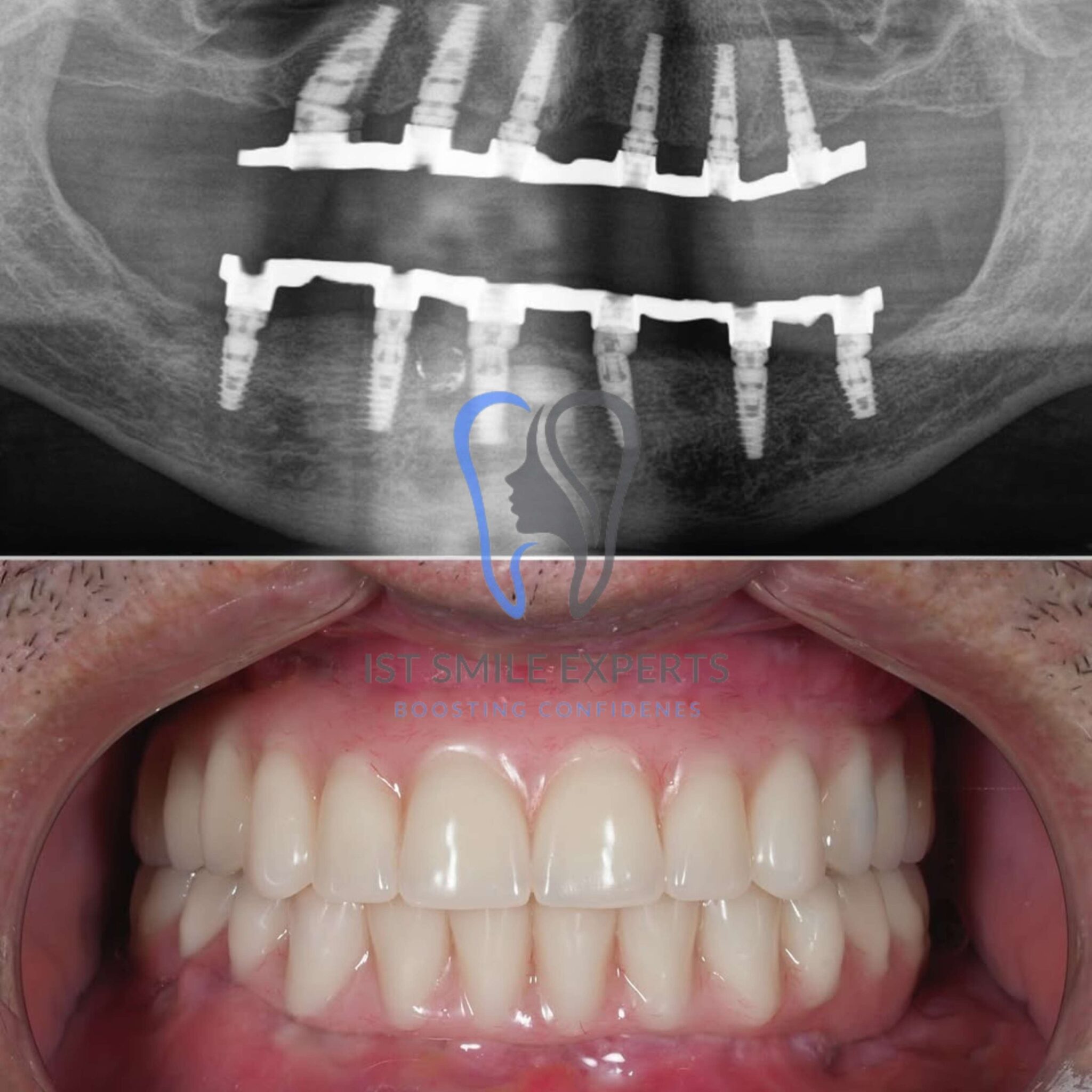The starting point for a full smile restoration with dental implants. Before photo of damaged teeth prior to a full mouth All-on-6 dental implant procedure in Turkey.