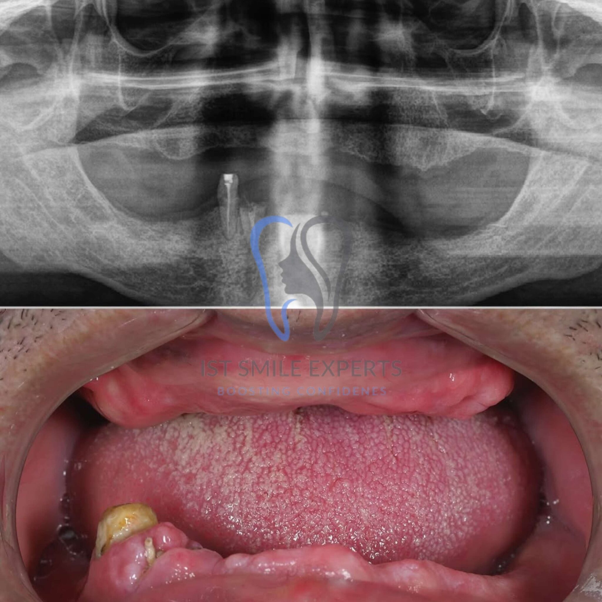 A complete smile transformation with full mouth dental implants in Turkey. After photo of a perfect smile result from a full mouth All-on-6 dental implant procedure at our Istanbul clinic.