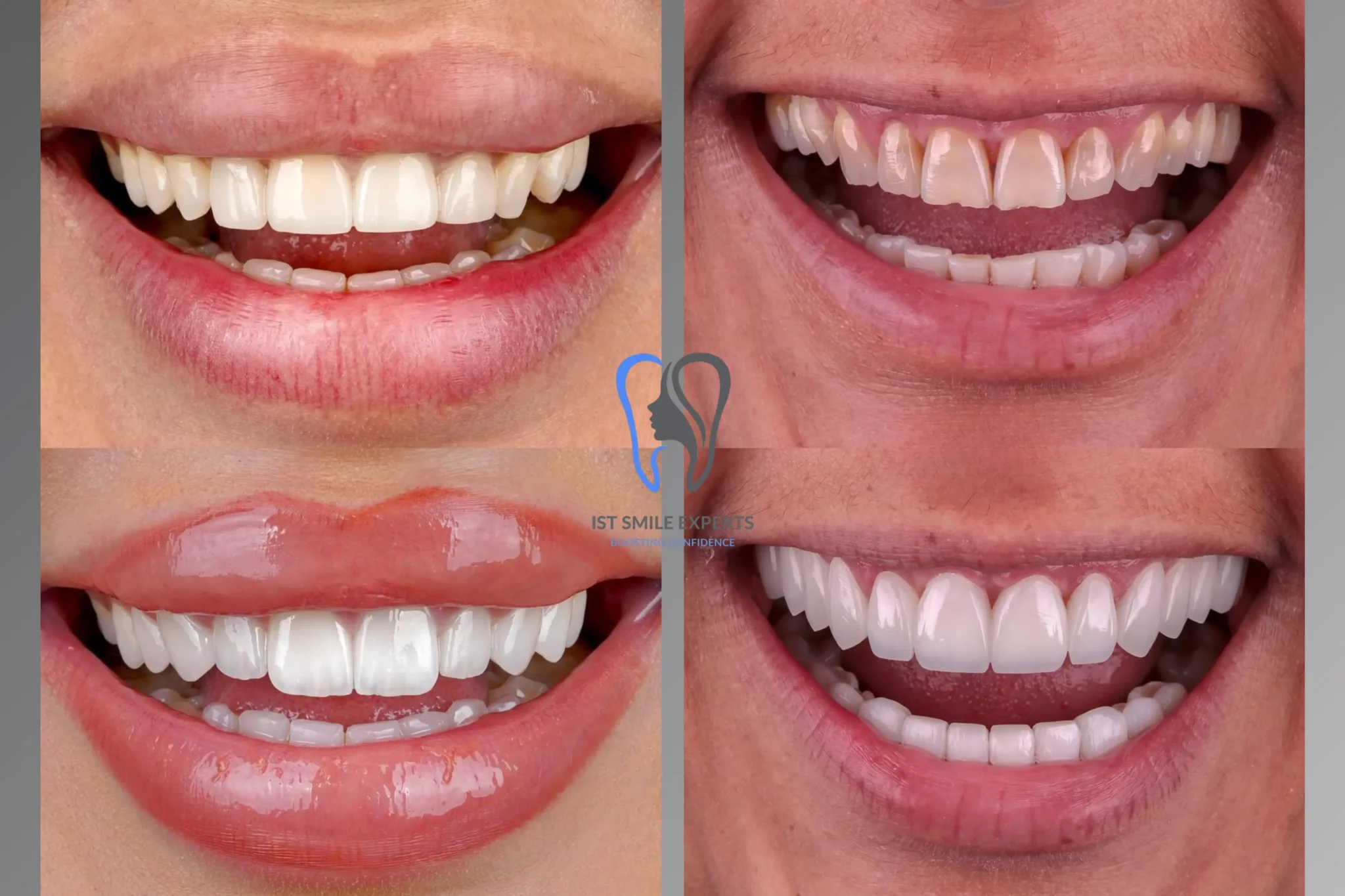 Hollywood Smile comparison Turkey: Zirconia crowns (right) vs Emax veneers (left) showing different transparency and result by IST SMILE EXPERTS, Istanbul.