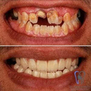 Smiling woman after Hollywood Smile makeover at IST Smile Experts Turkey
