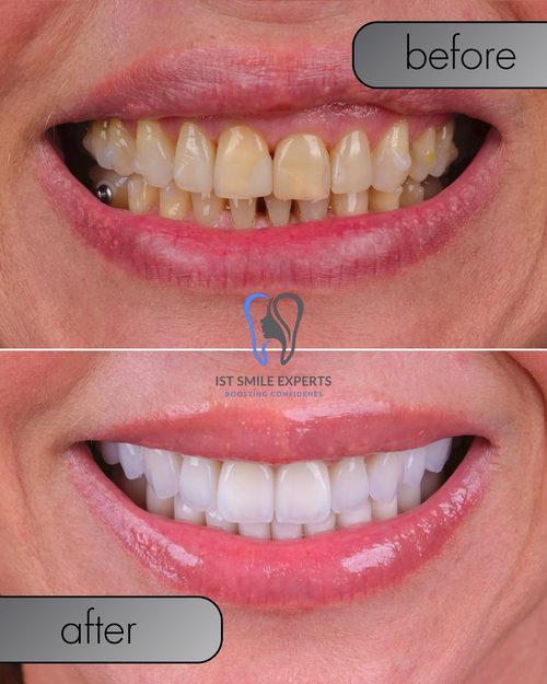 Before and after showing how long do turkish veneers last when done by IST SMILE experts