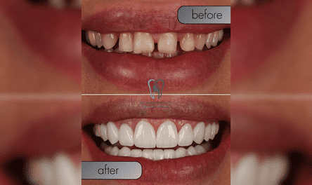 Is it worth getting teeth done in Turkey? A real before and after result of a safe smile makeover at IST SMILE EXPERTS.