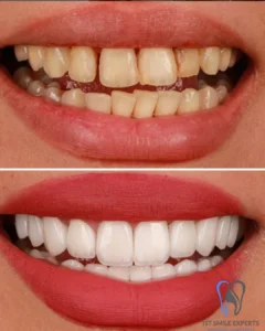 Before and after full Hollywood Smile makeover using Emax Porcelain Veneers in Turkey. Transformation of yellow, uneven teeth to a perfect white smile by IST SMILE EXPERTS Istanbul