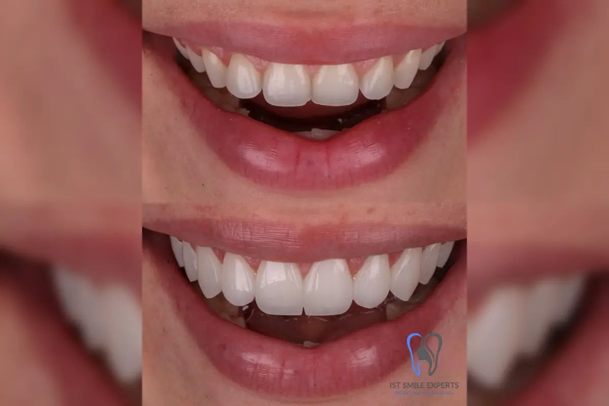 Emax veneers before and after Turkey Hollywood Smile transformation, showing natural light reflection and full smile makeover by IST SMILE EXPERTS.