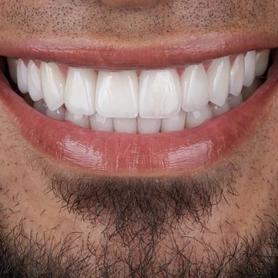 Before and after of a 10-veneer Hollywood Smile makeover at IST SMILE EXPERTS