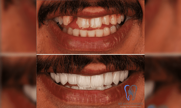 Hollywood Smile before and after transformation at IST Smile Experts in Turkey