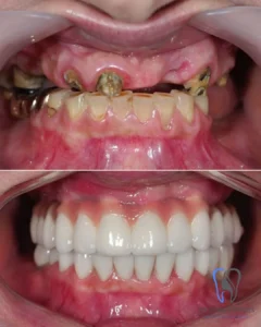 efore and after full mouth dental implants in Turkey (All-on-6 technique) showing complete restoration of severe tooth loss at IST SMILE EXPERTS Istanbul.