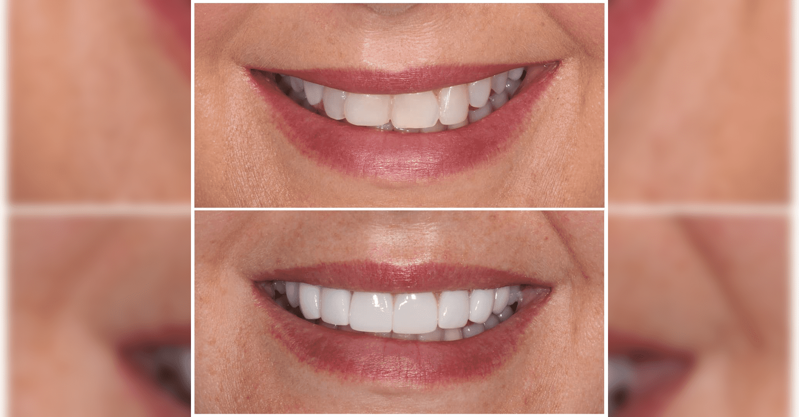 Before and after result of Composite Bonding in Turkey at IST SMILE EXPERTS, showing gap closure and whitening without drilling (No-Prep) using premium 3M resin - 2026 Portfolio