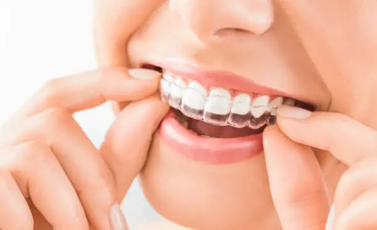 Close-up of a woman placing a clear aligner over her upper teeth, showing invisible orthodontic treatment at IST Smile Experts in Turkey.