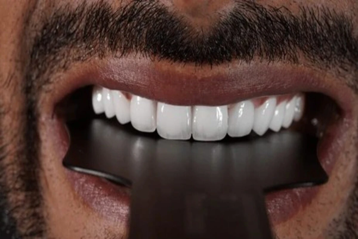 Close-up of a male patient displaying a perfect Hollywood Smile in Turkey with bright white veneers, using a black dental contrastor to highlight tooth shape and whiteness.