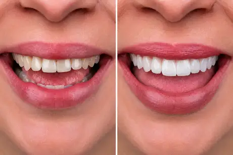 Hollywood smile before and after with E-Max veneers at IST Smile Experts Turkey, showing whiter, aligned upper teeth