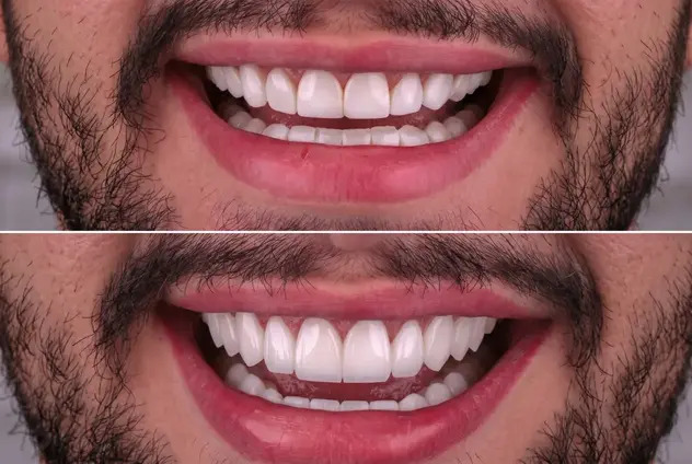 Veneer replacement in Turkey - clinical revision of failed cosmetic dentistry showing before and after E-Max veneer redo at IST Smile Experts Istanbul 2026