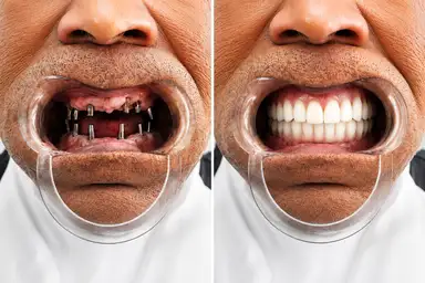 All-on-6 before and after full smile restoration with fixed implant-supported teeth in Istanbul Turkey by IST Smile Experts