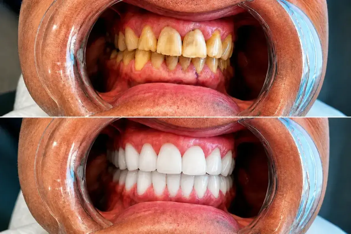 Before and after E-Max smile makeover case at IST Smile Experts in Istanbul showing an Australian patient treated with veneers and crowns for a brighter, more symmetrical, natural-looking smile.