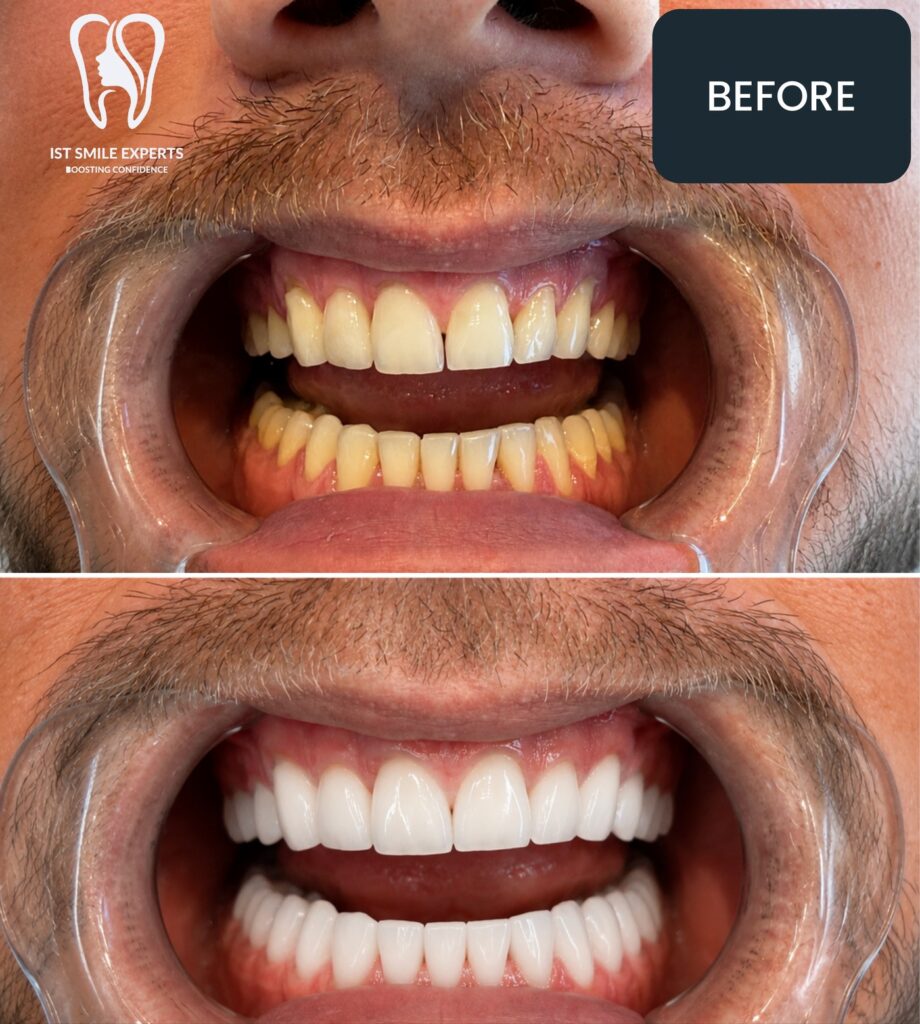 Before and after: E-Max full smile makeover at IST Smile Experts, Istanbul