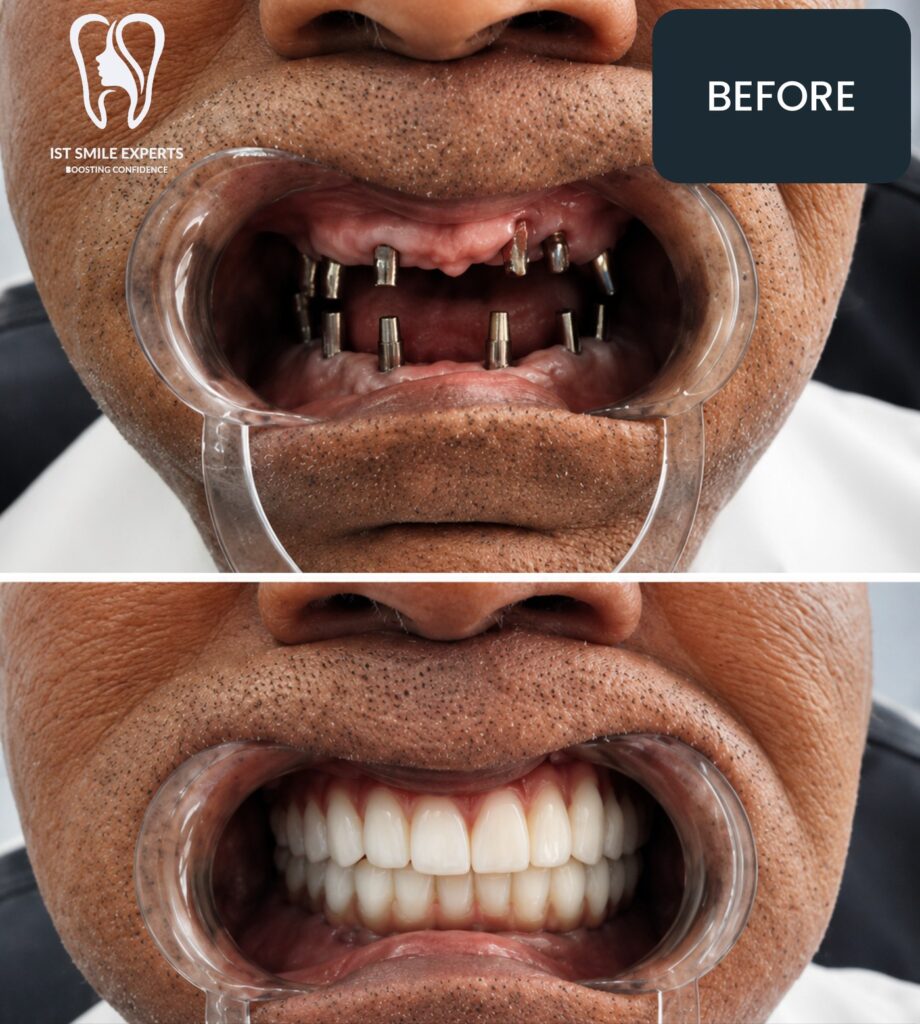 Before and after: Full-arch fixed teeth, upper and lower at IST Smile Experts, Istanbul