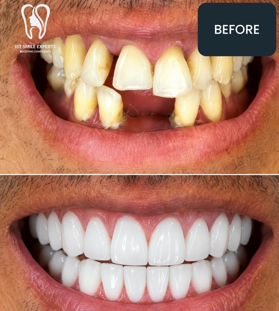 Before and after: Crowded and missing teeth rebuilt at IST Smile Experts, Istanbul