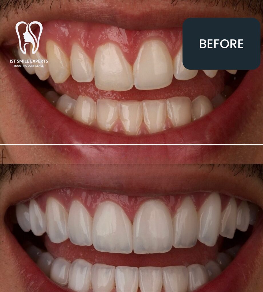 Before and after: Upper and lower smile makeover at IST Smile Experts, Istanbul